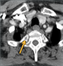 Die Abbildung zeigt eine Computertomographie-Aufnahme des Thorax des Patienten zum Zeitpunkt der Erstdiagnose.