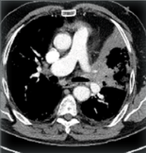 Die Abbildung zeigt eine Computertomographie-Aufnahme des Thorax des Patienten zum Zeitpunkt der Erstdiagnose.