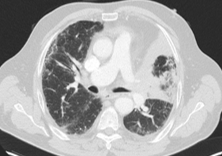 Die Abbildung zeigt eine Computertomographie-Aufnahme des Thorax des Patienten zum Zeitpunkt der Erstdiagnose.