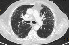 Die Abbildung zeigt eine Computertomographie-Aufnahme des Thorax des Patienten zum Zeitpunkt der Erstdiagnose.