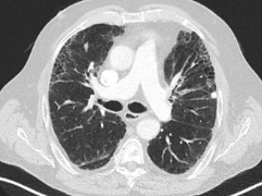 Die Abbildung zeigt eine Computertomographie-Aufnahme des Thorax des Patienten zum Zeitpunkt der Erstdiagnose.